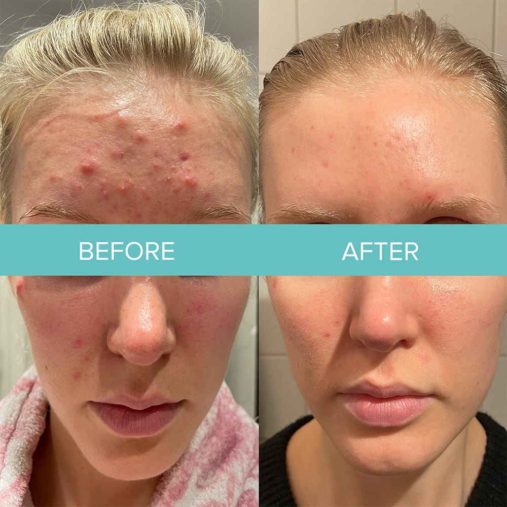 Allison-Drayton-Allison-Drayton-NeoGen1- targeted scar treatment-acne solution